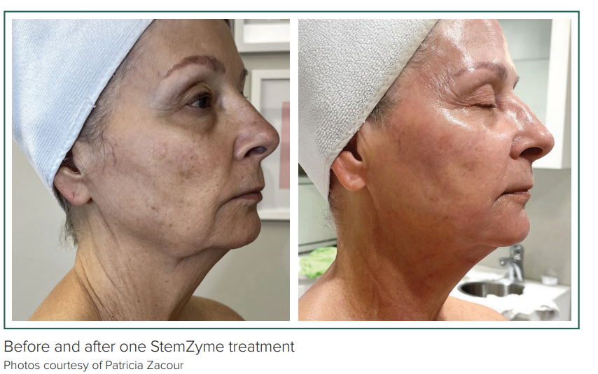 Enzyme Treatment Protocol Harnesses Power of Skin’s Stem Cells