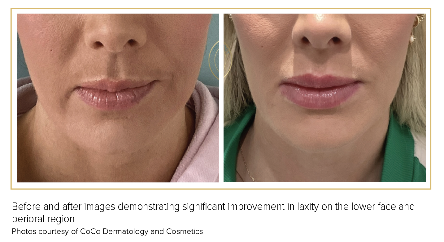 Improving Post-Weight-Loss Skin with Radiofrequency Microneedling