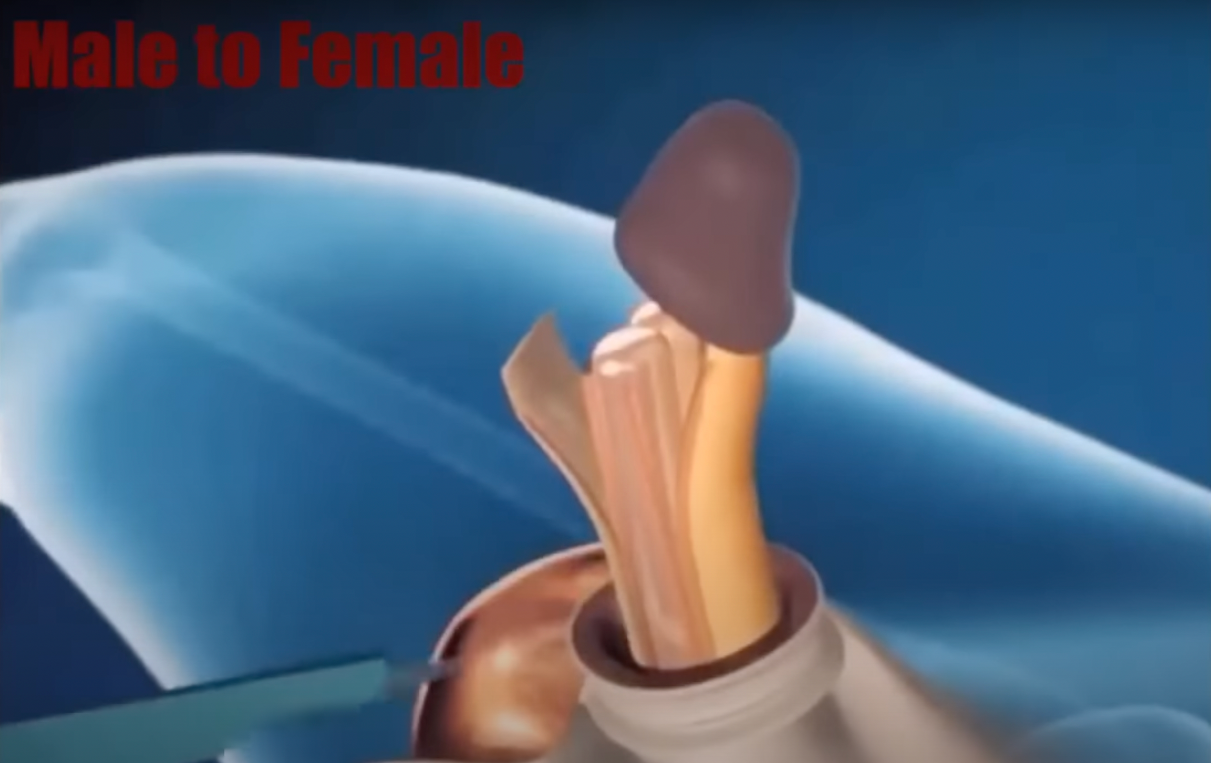 Video showing male to female surgery is 'fascinating' viewers