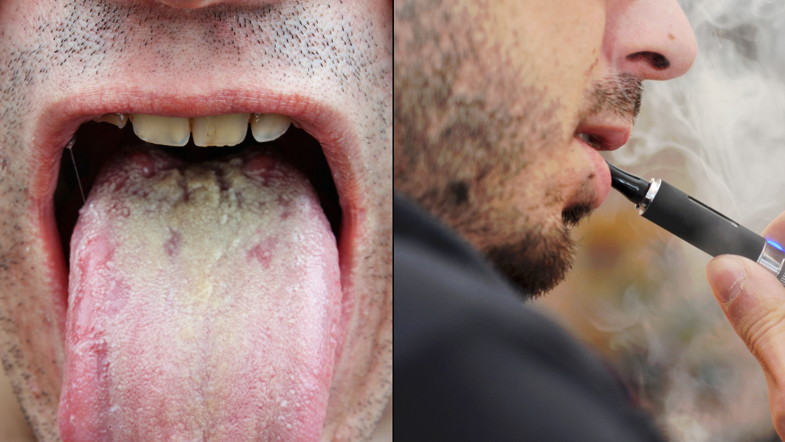 Dentist issues warning over grim side effects of 'Vaper's Tongue'
