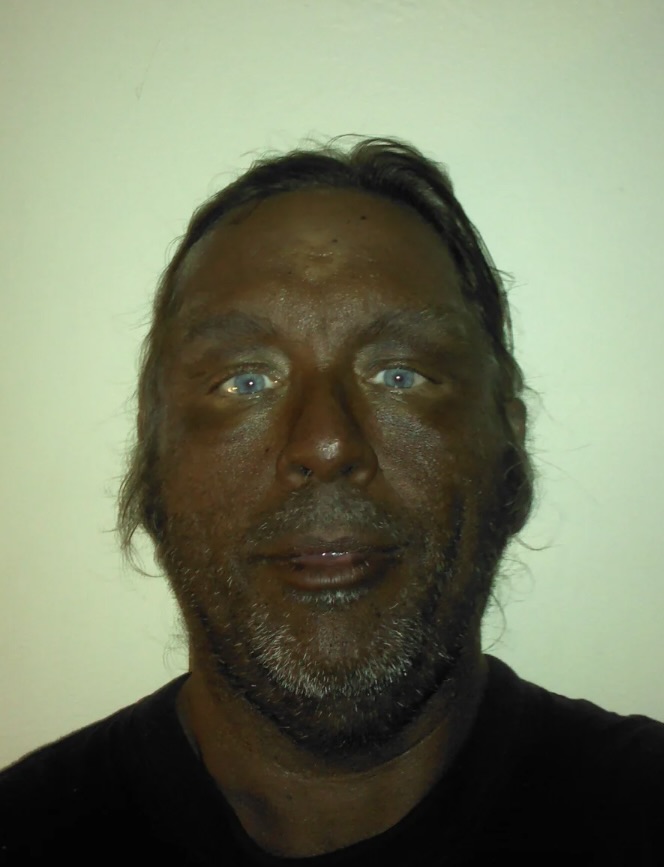 Man who's injected Melanotan II for years shares before and after photos