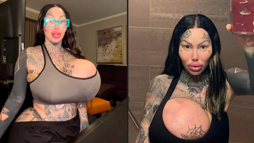 Instagram model left with huge 'uniboob' after one of her implants
