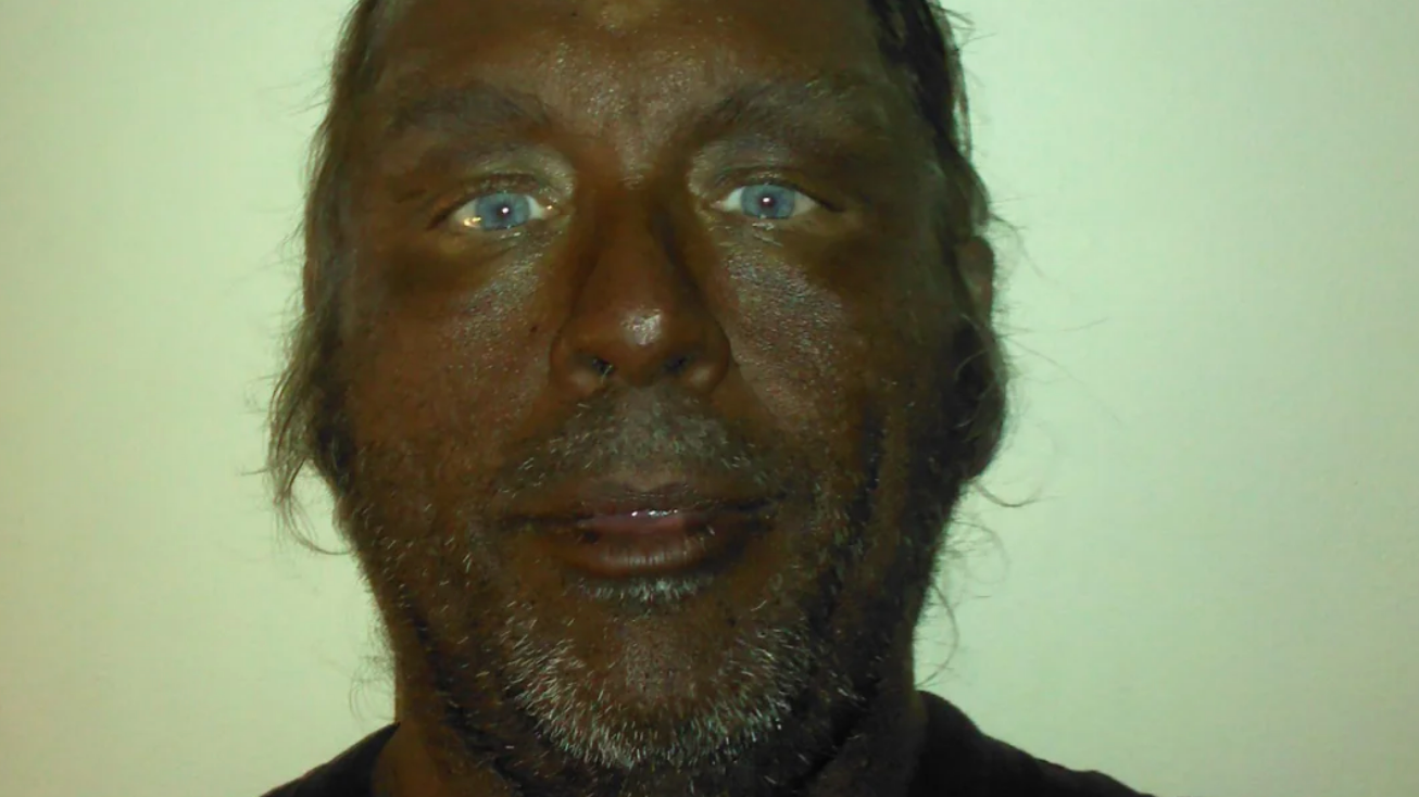 before and after melanotan ii Medium MT2 My results, Day 0