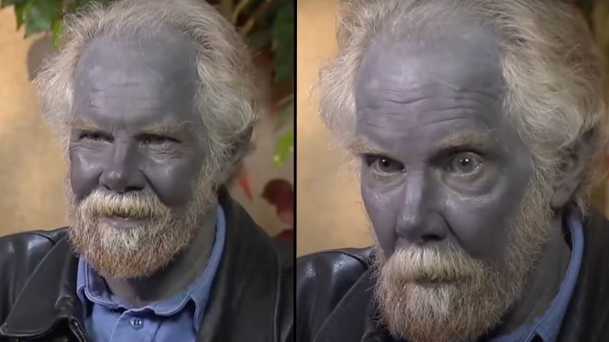 Bizarre 'Papa Smurf' resurfaces on the internet; know how overuse of  colloidal silver caused a man to turn blue