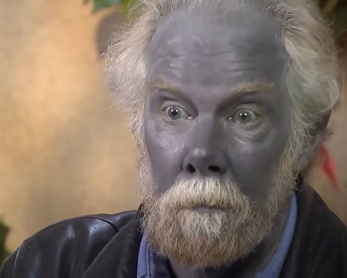 The man who turned blue after taking a dietary supplement for years