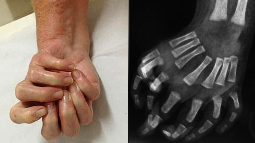 Rare 'mirror hand' syndrome causes one hand to be completely