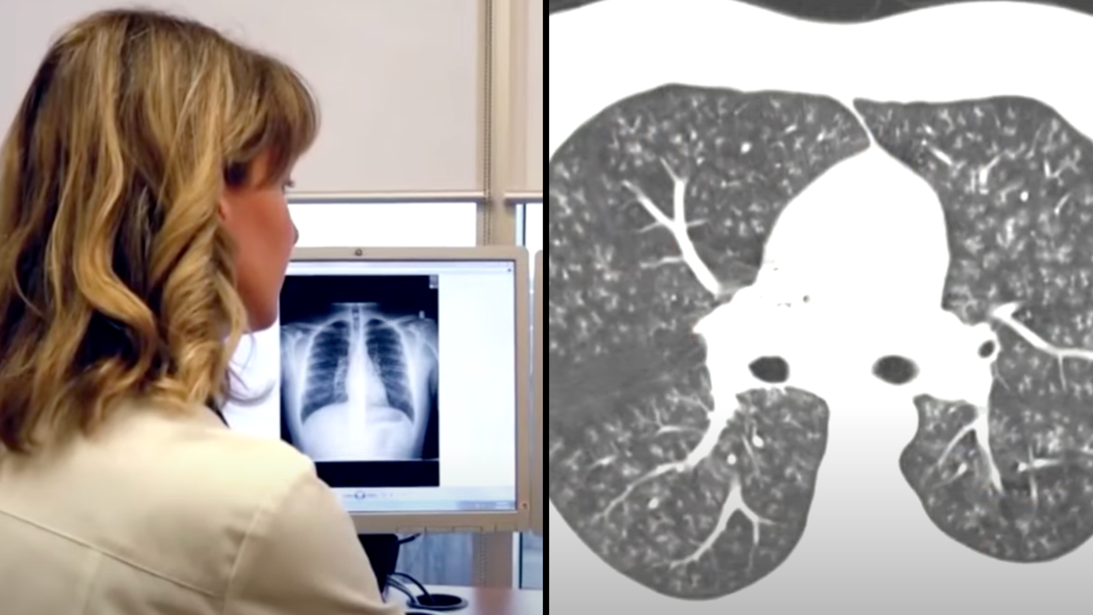 how much is elf bar vape Doctor shows x-ray of 'popcorn lung' caused from vaping and it can be fatal