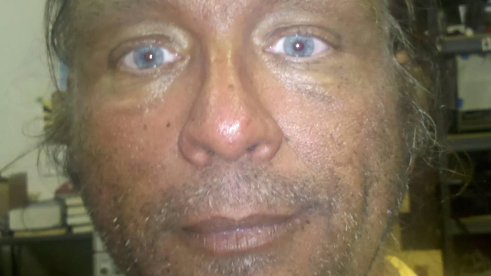 Man who's injected Melanotan II for years shares before and after photos
