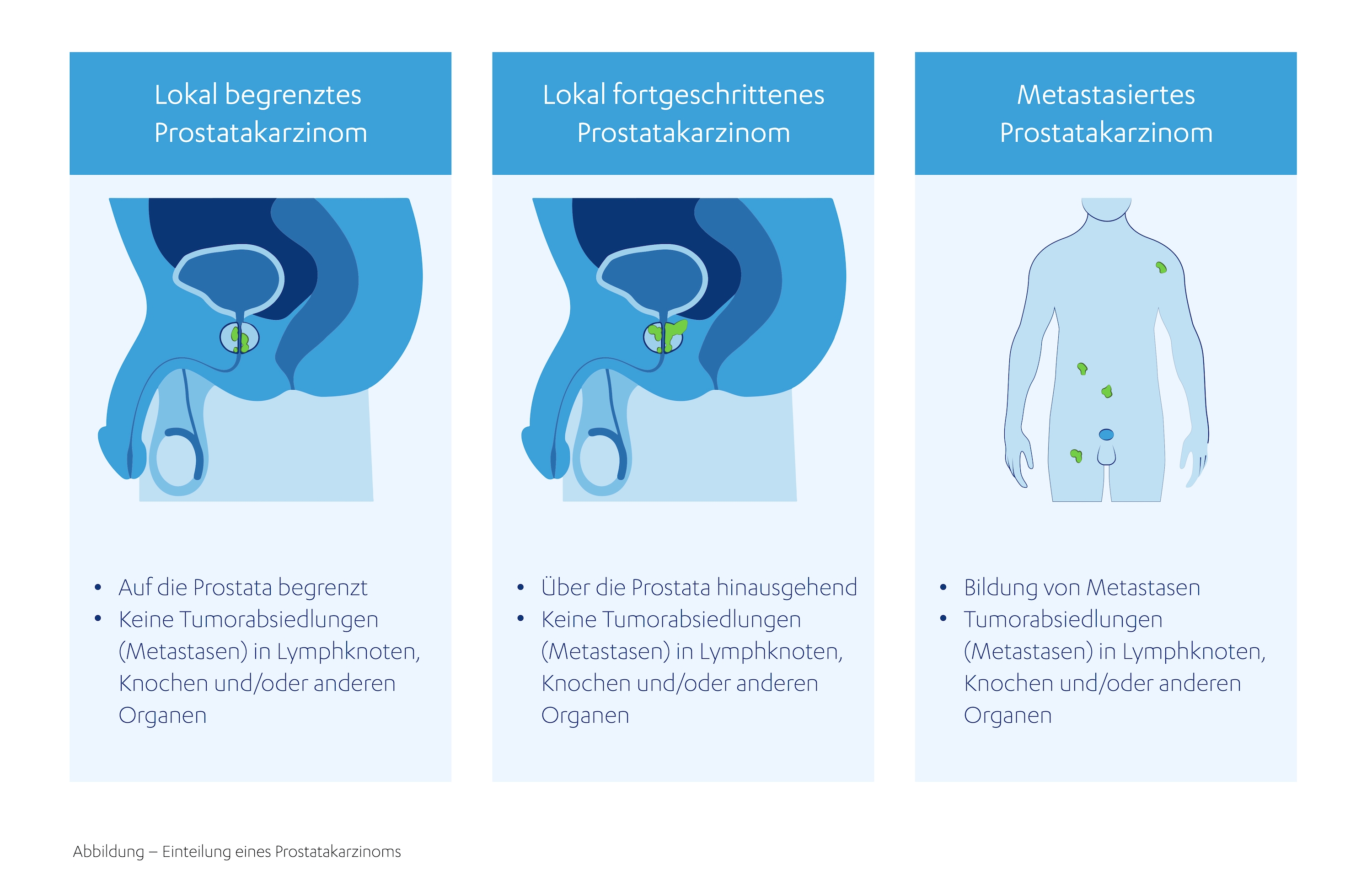 Prostatakrebs: Symptome, Diagnose & Behandlung | JanssenWithMe