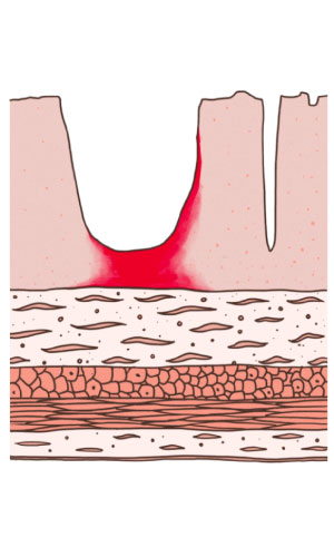 Zeichnung der Darmwand mit einer Entzündung, die bei der Colitis ulcerosa nur die innerste Darmwandschicht betrifft – die Darmschleimhaut. 