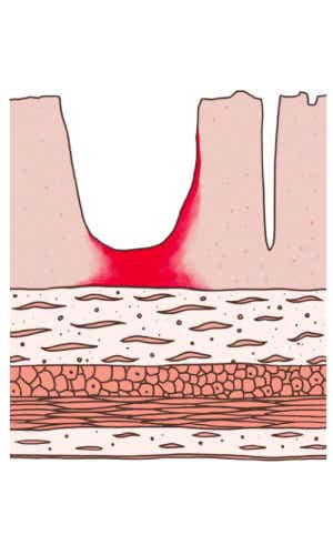 Darmwand bei Colitis ulcerosa. Zeichnung der Darmwand mit einer Entzündung, die bei der Colitis ulcerosa nur die innerste Darmwandschicht betrifft – die Darmschleimhaut.