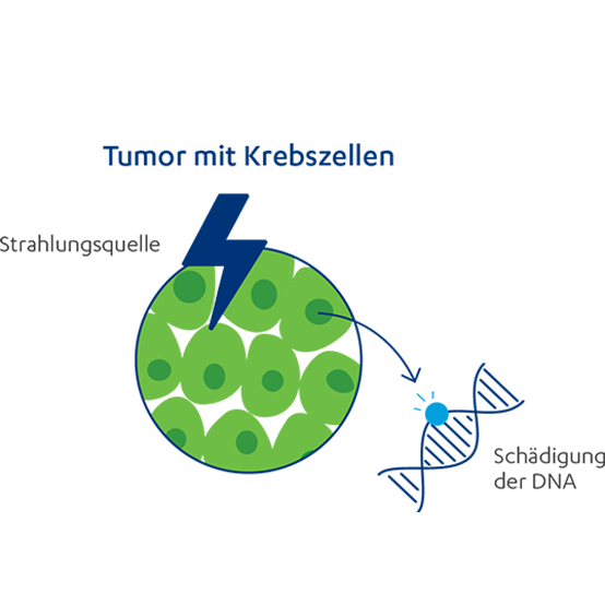 Abbildung der Funktion einer Strahlentherapie: Tumor mit Krebszellen