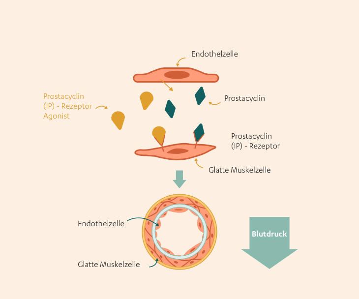 Prostacyclin: Illustration medikamentoese therapie ohne rezeptorantagonist