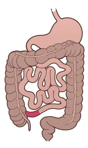 Zeichnung des Magen-Darm-Traktes mit roter Färbung des letzten Stücks des Dünndarms, auch terminales Ileum genannt.