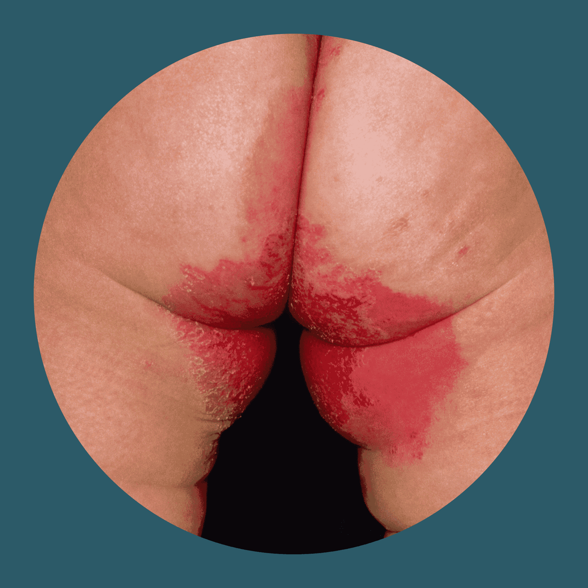 Plaques zwischen dem Gesäß bei Psoriasis inversa