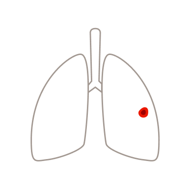Schematische Darstellung der Lunge mit kleinem Tumor im rechten Lungenflügel bei Lungenkrebs im Stadium I.