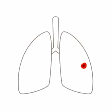 Schematische Darstellung von Lungenkrebs im Stadium I Schematische Darstellung der Lunge mit kleinem Tumor im rechten Lungenflügel bei Lungenkrebs im Stadium I.
