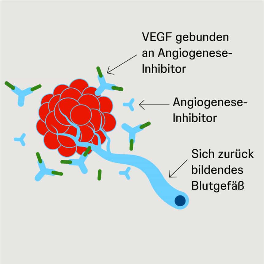 Angiogenese-Inhibitoren blockieren VEGF-Signale Schematische Darstellung von Angiogenese-Inhibitoren, die VEGF binden und die Signalweitergabe an Blutgefäße verhindern.