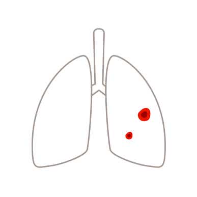Die Lunge im Krankheitsstadium 3 bei Lungenkrebs