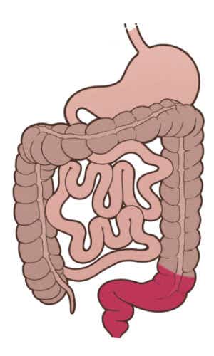 Proktitis ulcerosa, bei der nur der Enddarm betroffen ist. Zeichnung des Magen-Darm-Traktes mit roter Färbung des Enddarms, der bei der Proktitis ulcerosa betroffen ist.