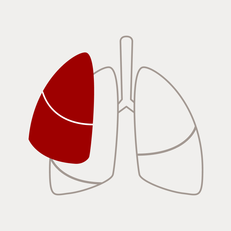 Schematische Darstellung einer Bilobektomie mit Entfernung von zwei rot markierten Lungenlappen links.