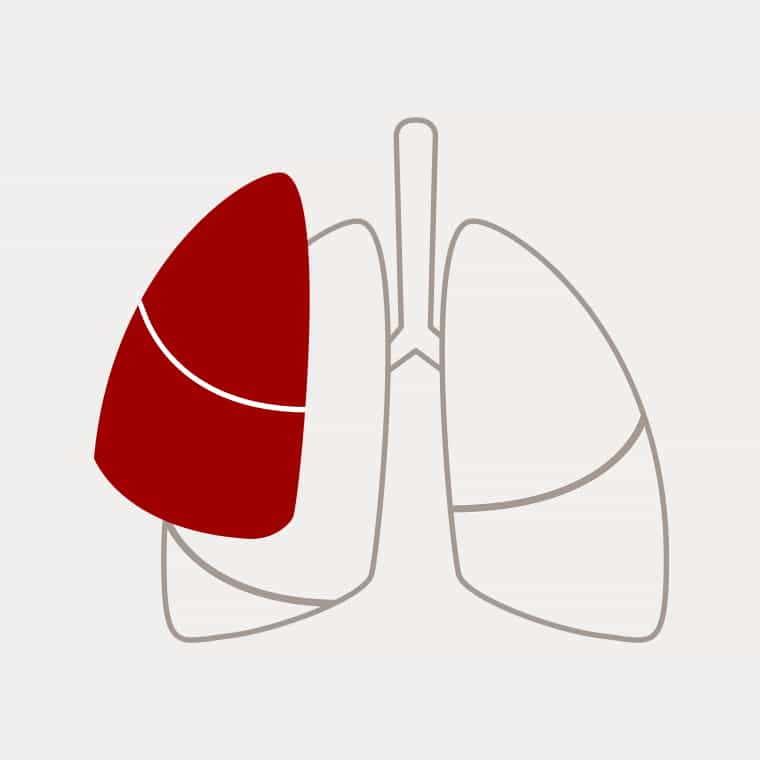 Schematische Darstellung einer Bilobektomie Schematische Darstellung einer Bilobektomie mit Entfernung von zwei rot markierten Lungenlappen links.