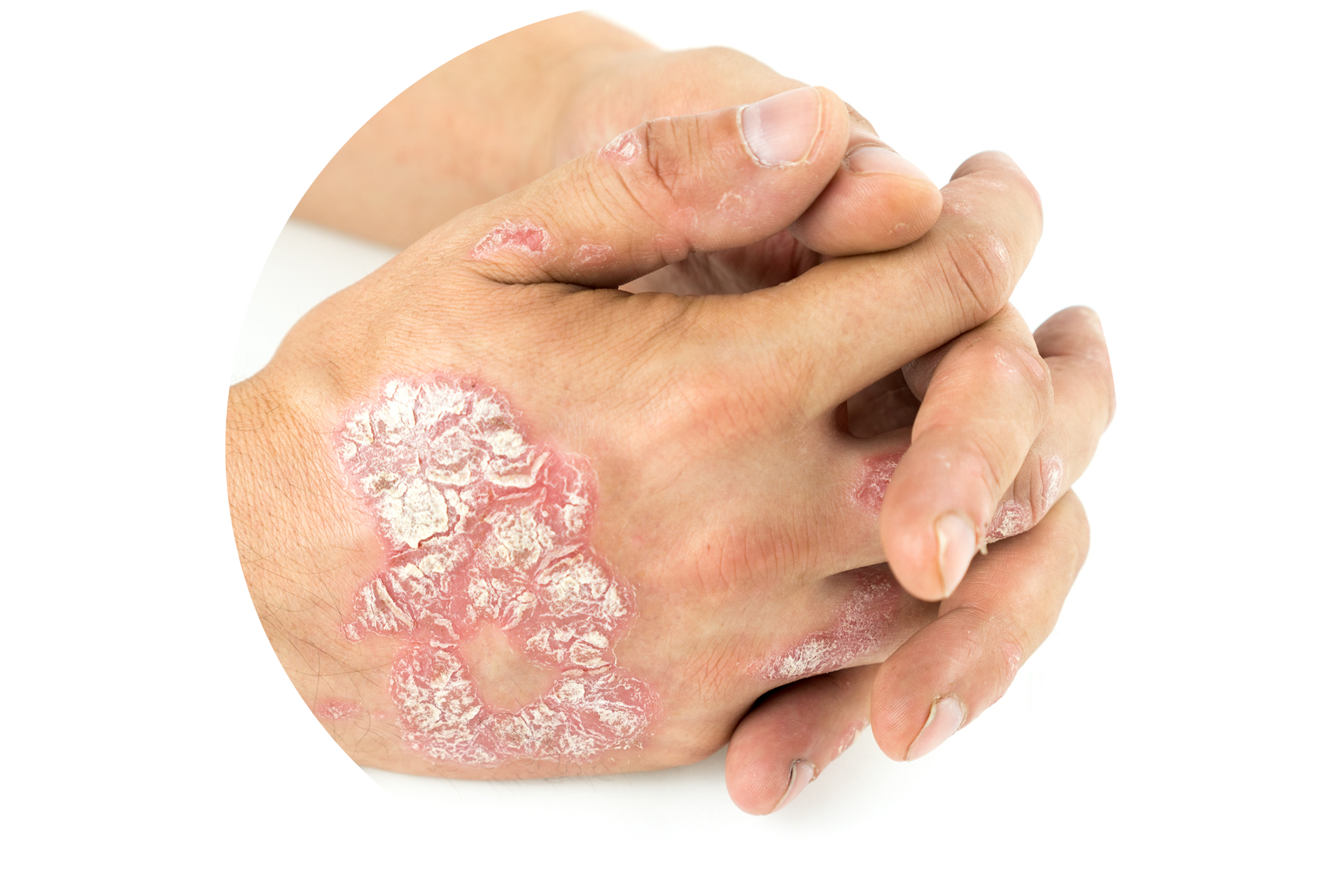 Psoriasis: Ursachen & Symptome Der Schuppenflechte | JanssenWithMe