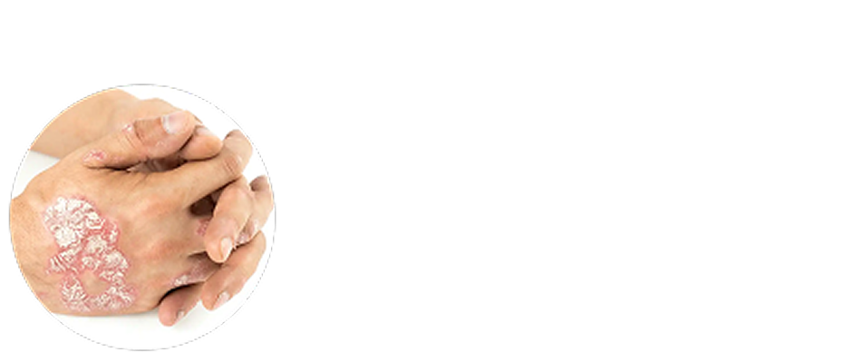 Weiße Psoriasis-Plaques am Handrücken