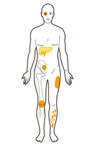 Zeichnung einer Person mit Morbus Crohn mit gelben Markierungen der extraintestinalen Manifestationen an Augen, Haut, Gelenken und weiteren Organen.