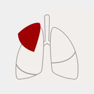 Schematische Darstellung einer Lobektomie Schematische Darstellung einer Lobektomie mit Entfernung eines rot markierten Lungenlappens im linken Lungenflügel.