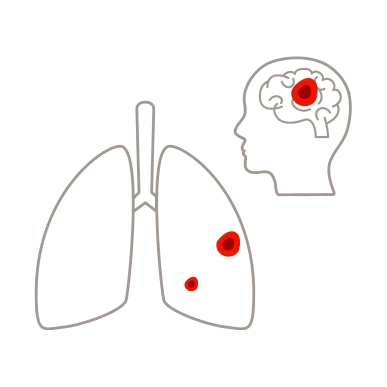 Die Lunge im Krankheitsstadium 4 bei Lungenkrebs