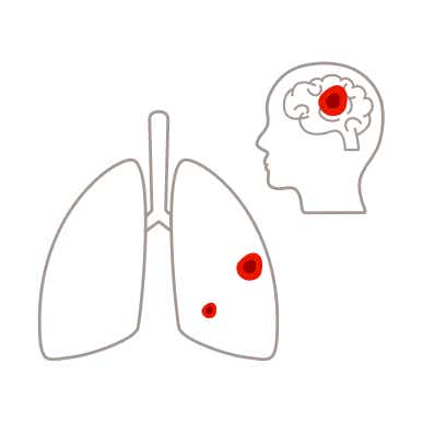 Die Lunge im Krankheitsstadium 4 bei Lungenkrebs
