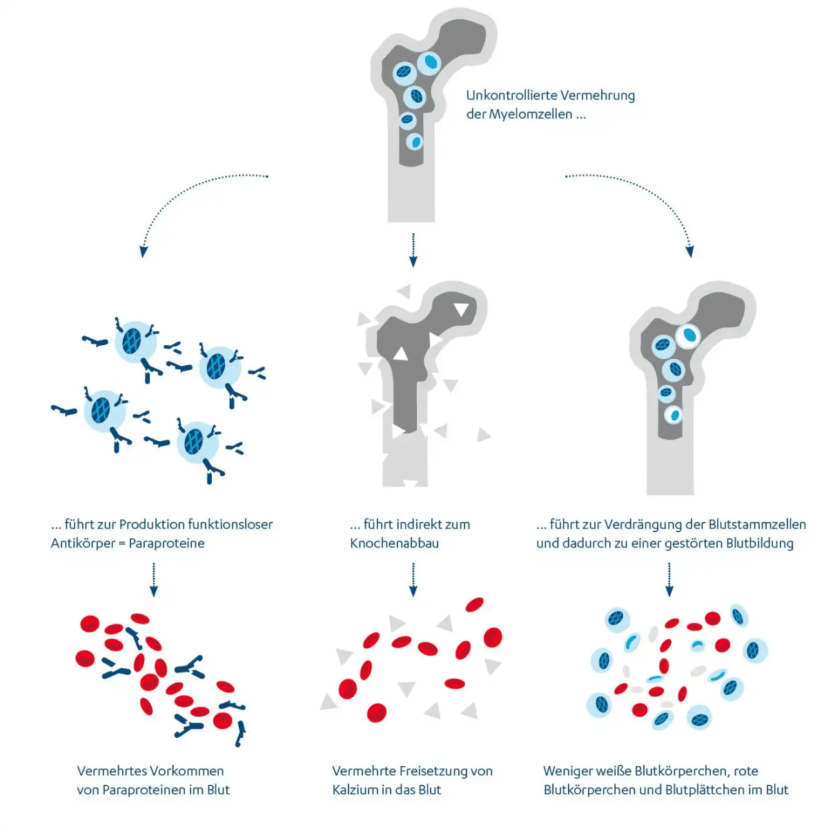 Multiples Myelom Symptome Lebenserwartung Therapie JanssenWithMe multiples-myelom-symptome-lebenserwartung-therapie-janssenwithme