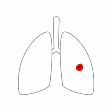 Schematische Darstellung von Lungenkrebs im Stadium II Schematische Darstellung der Lunge mit größerem Tumor im rechten Lungenflügel bei Lungenkrebs im Stadium II.