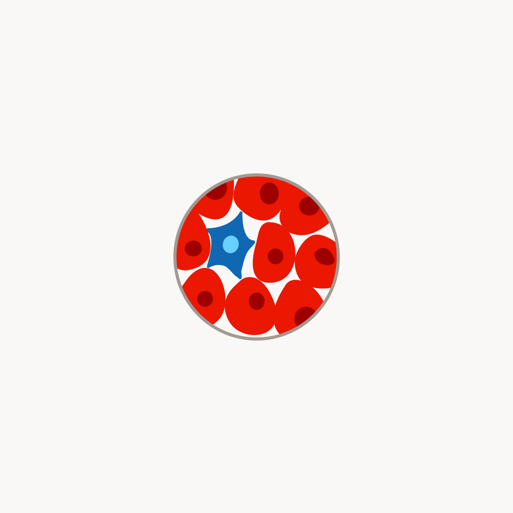 Schematische Darstellung eines Tumors mit einer blauen und mehreren rot markierten absterbenden Krebszellen.