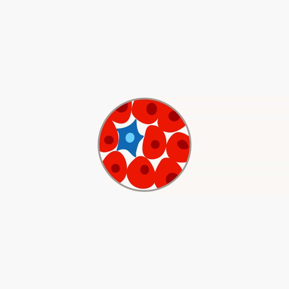 Strahlentherapie schädigt Krebszellen im Tumor Schematische Darstellung eines Tumors mit einer blauen und mehreren rot markierten absterbenden Krebszellen.
