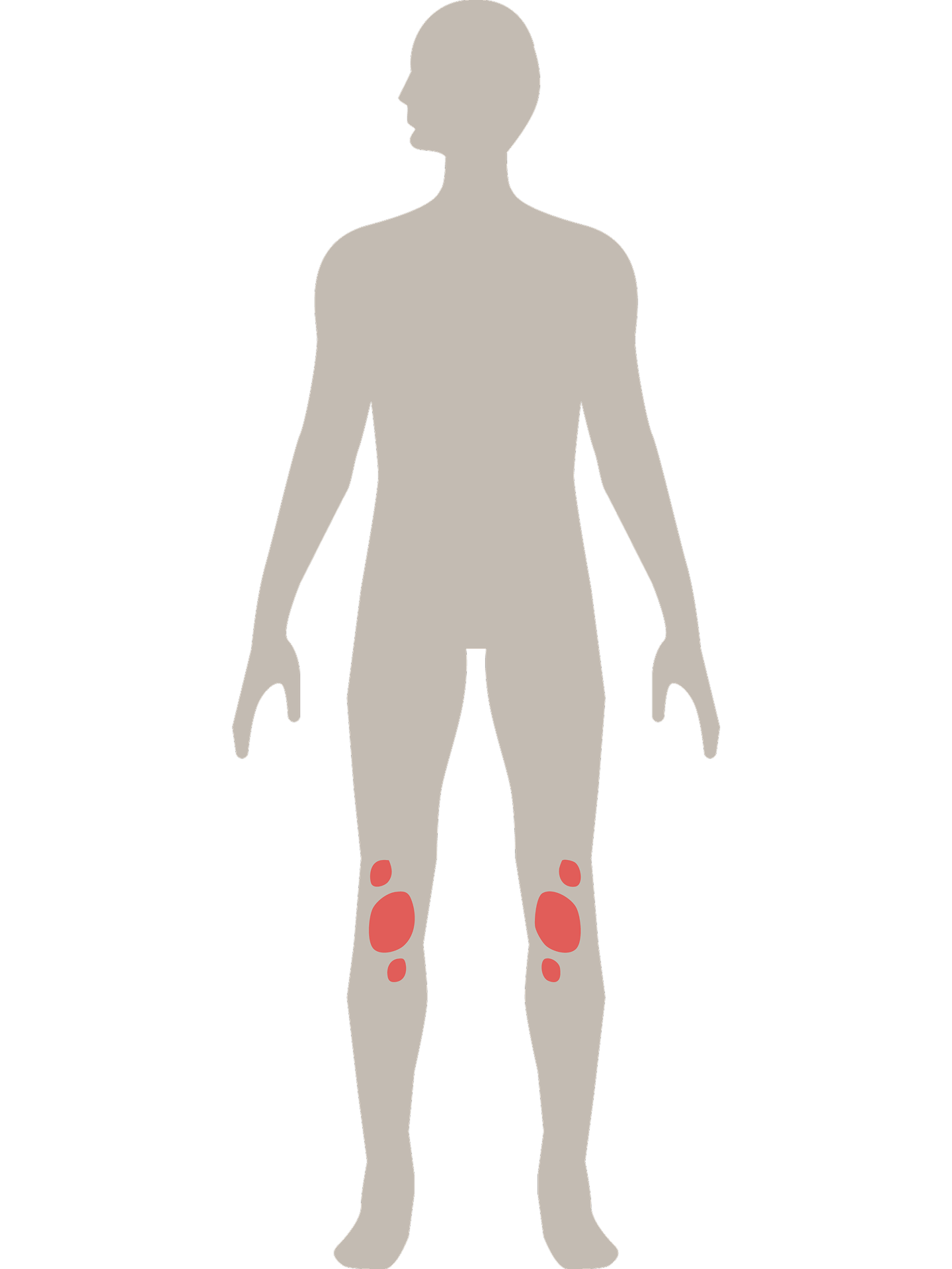 Mensch, dessen Psoriasis-Plaques sich auf die Knie beschränken
