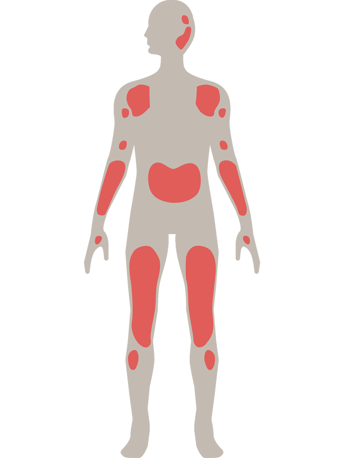 Mensch mit Schuppenflechte an Kopfhaut, Schultern, Armen, Rumpf und Beinen