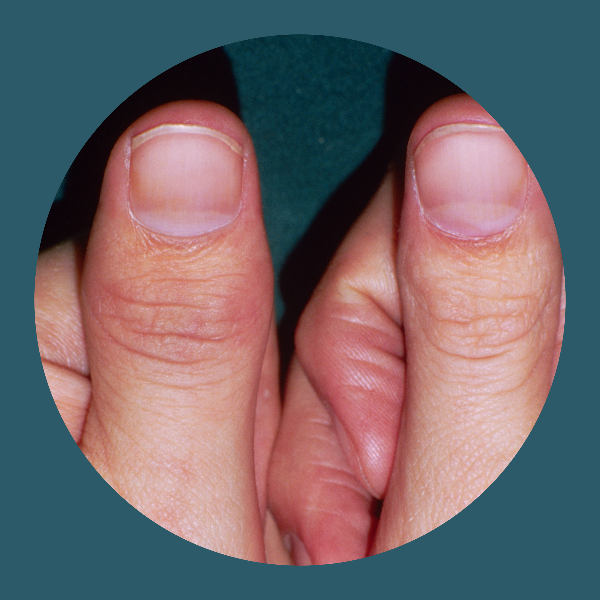 Geschwollene Daumengelenke einer Person mit Psoriasis-Arthritis 