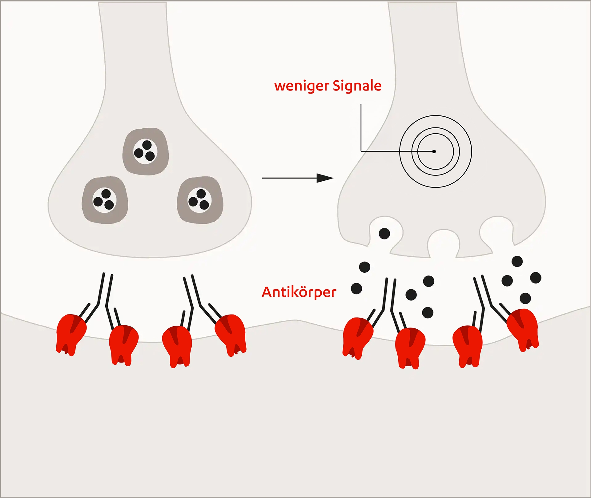 Gestörte Signalübertragung bei Myasthenia gravis, mit blockierten Rezeptoren durch Autoantikörper und fehlender Botenstoffbindung