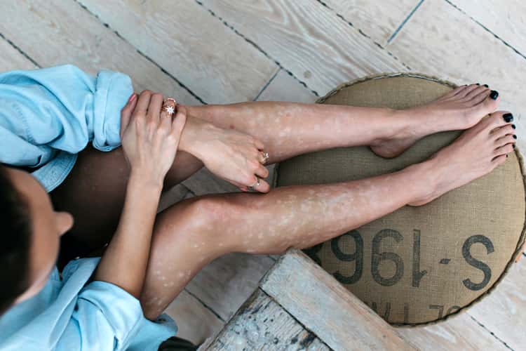 psa-hero-psa-verstehen Psoriasis-Arthritis: Dame hält sich ihr schmerzendes
Handgelenk