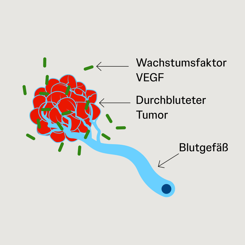 Schematische Darstellung eines Tumors, der über VEGF-Signale die Bildung neuer Blutgefäße anregt.
