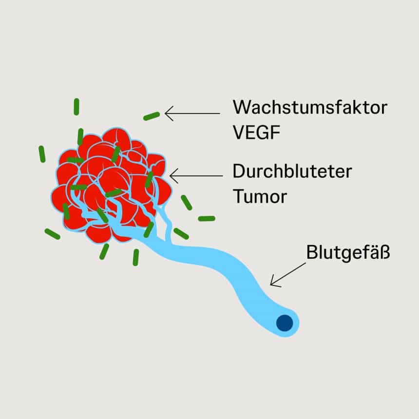 VEGF fördert die Bildung neuer Blutgefäße im Tumor Schematische Darstellung eines Tumors, der über VEGF-Signale die Bildung neuer Blutgefäße anregt.