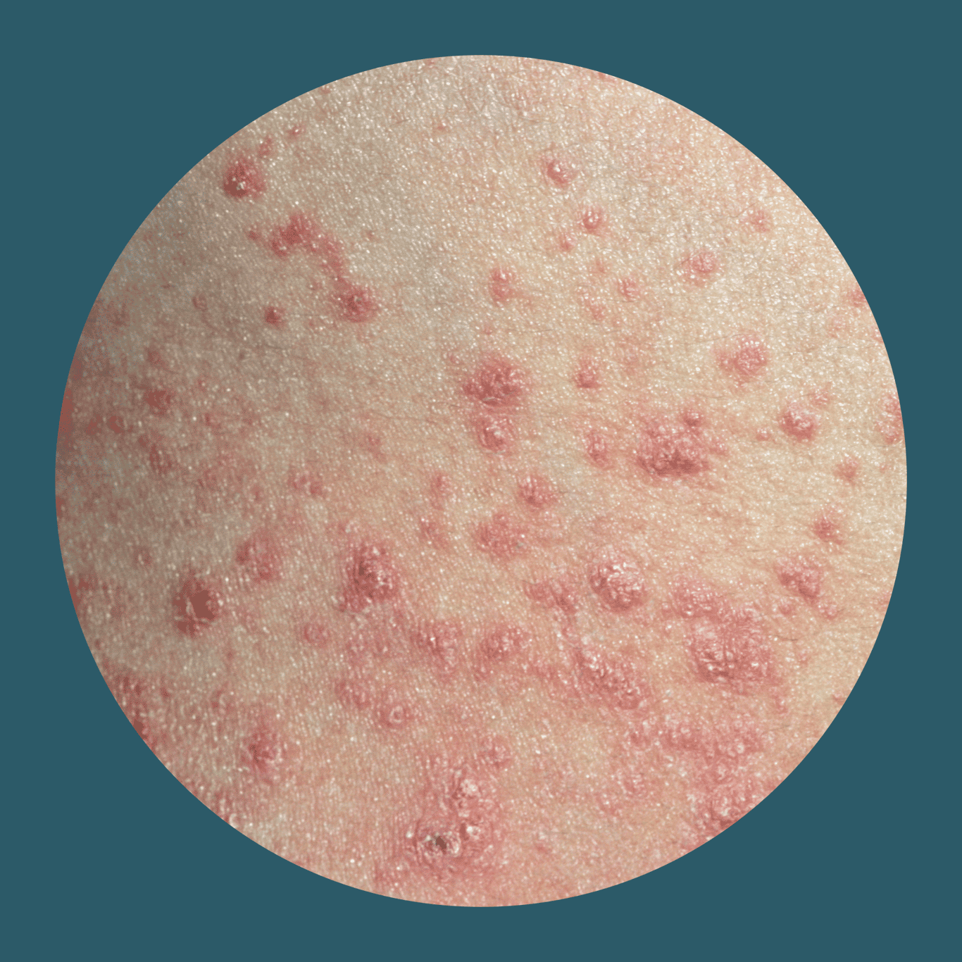 Psoriasis Ursachen Symptome Der Schuppenflechte JanssenWithMe psoriasis-ursachen-symptome-der-schuppenflechte-janssenwithme