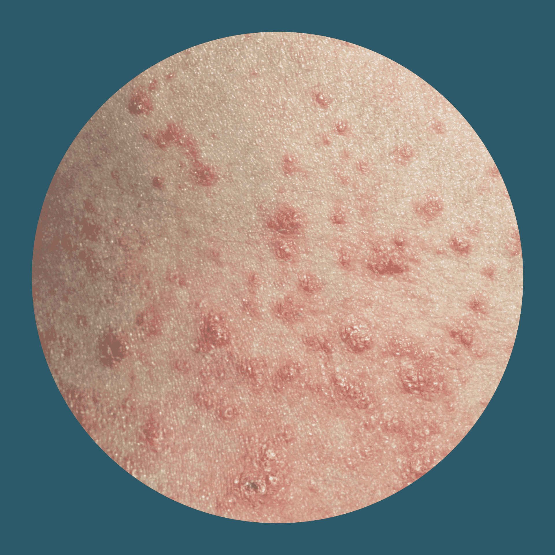 Tröpfchenförmige rote Plaques auf der Haut bei Psoriasis guttata