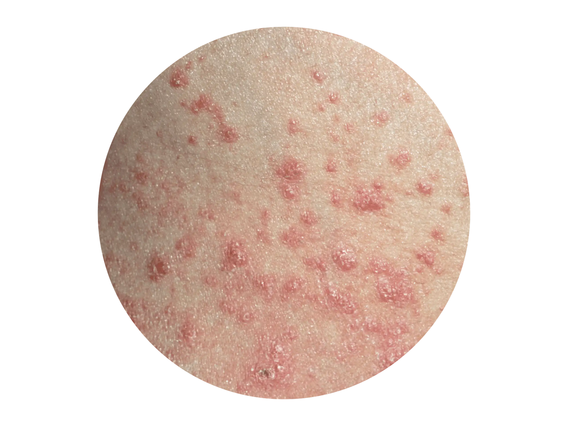 Tröpfchenförmige rote Plaques auf der Haut bei Psoriasis guttata Tröpfchenförmige rote Plaques auf der Haut bei Psoriasis guttata