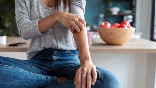 Eine Frau mit Morbus Crohn, bei der sich die Entzündung auch außerhalb des Darms abspielt und die Haut betrifft.
