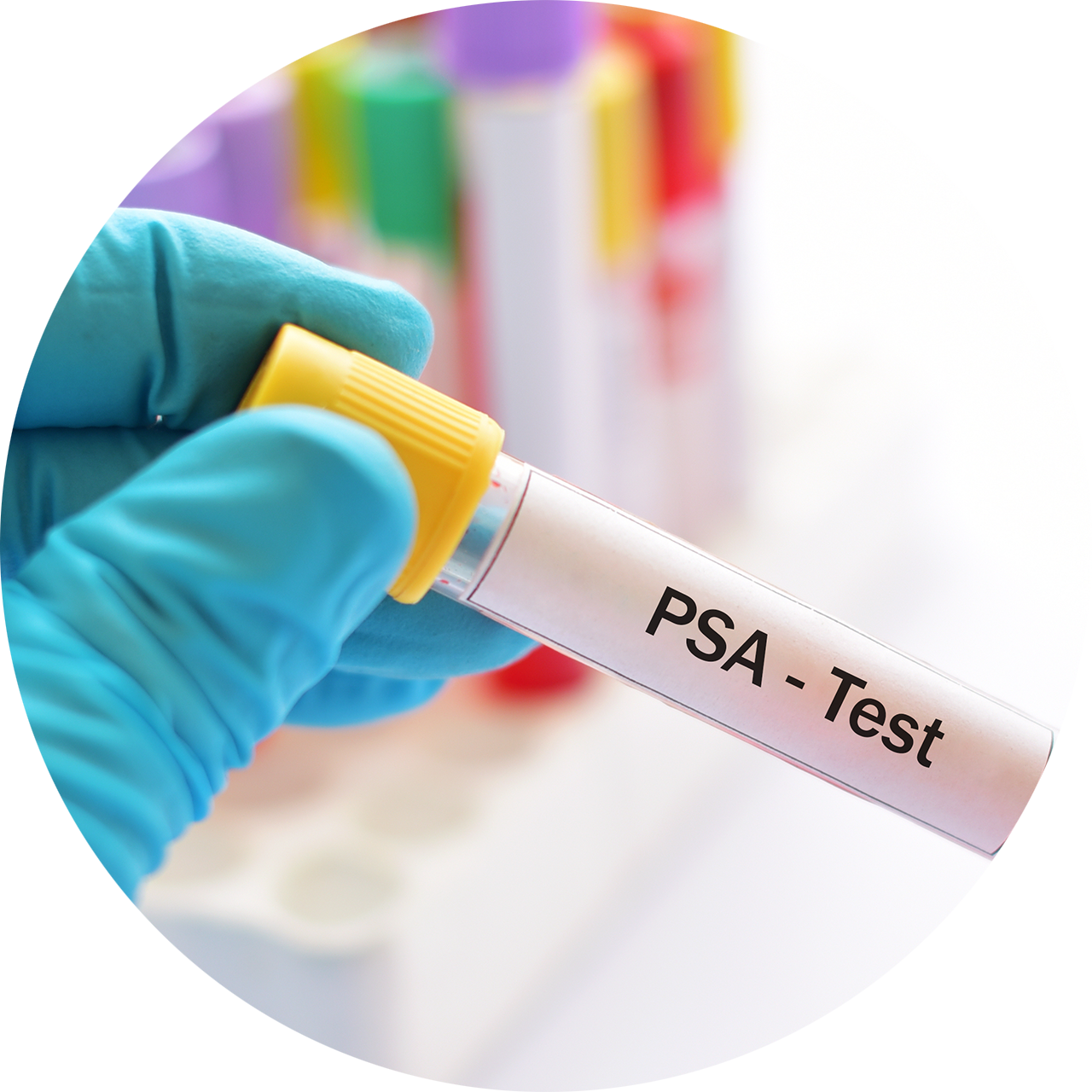 PSA-Test zur Früherkennung von Prostatakrebs