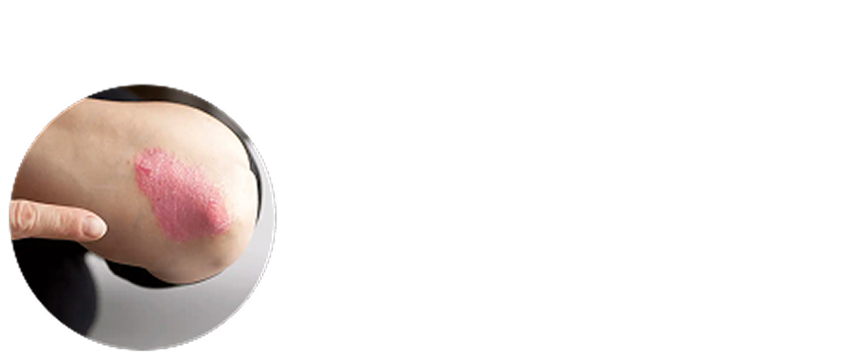 Schuppen am Ellbogen Schuppen am Ellbogen