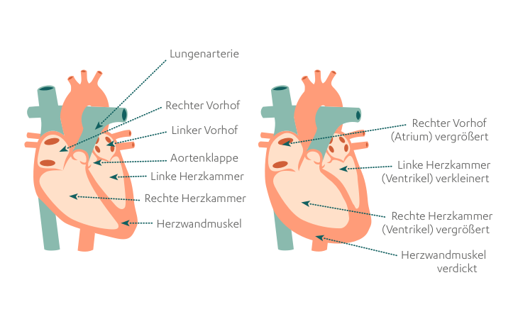 Herzfehler: gesundes Herz, Herz bei PAH